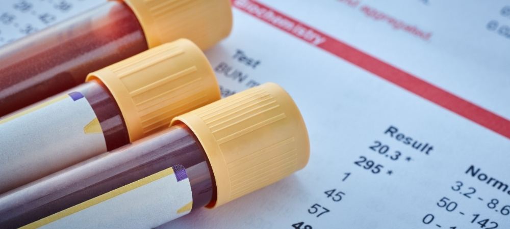 Three blood sample tubes with yellow caps resting on a biochemistry blood test results sheet